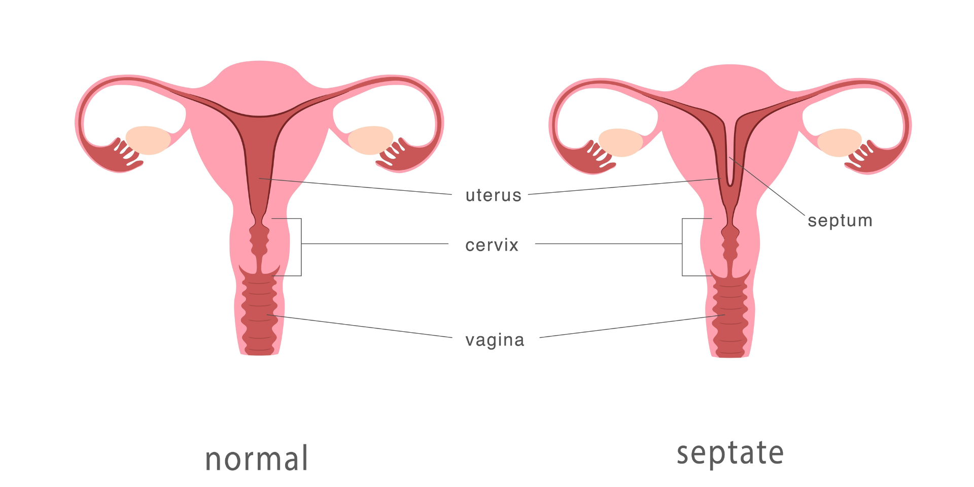 διάφραγμα μήτρας